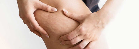 Cellulite